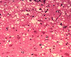 Brain Tissue with Mad Cow Disease